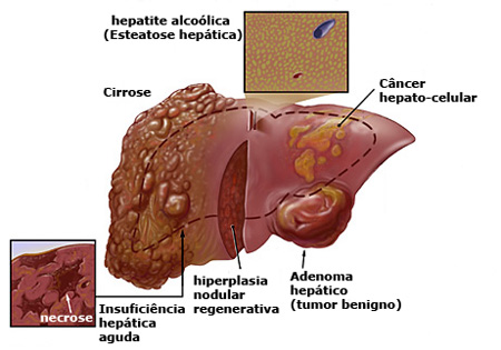 Hepatite