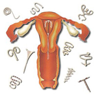 Dispositivo Intra-Uterino